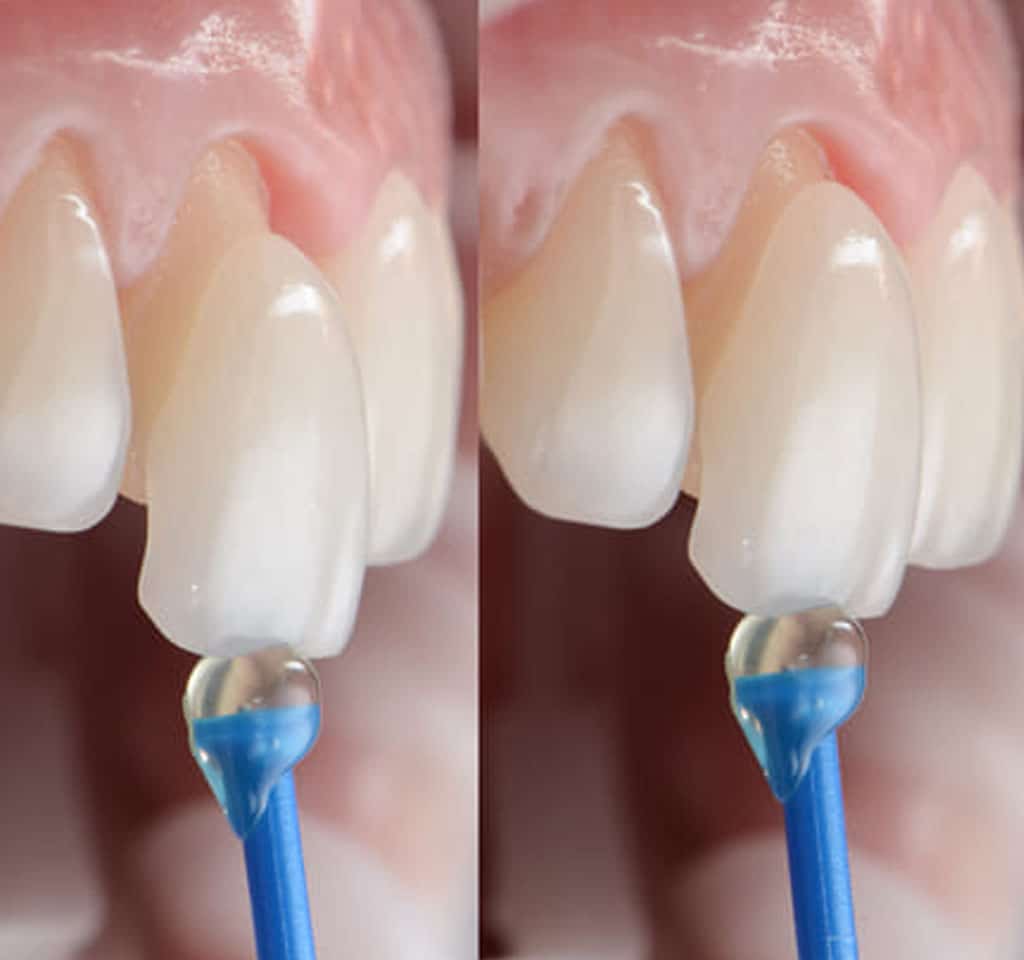 carillas dentales porcelana