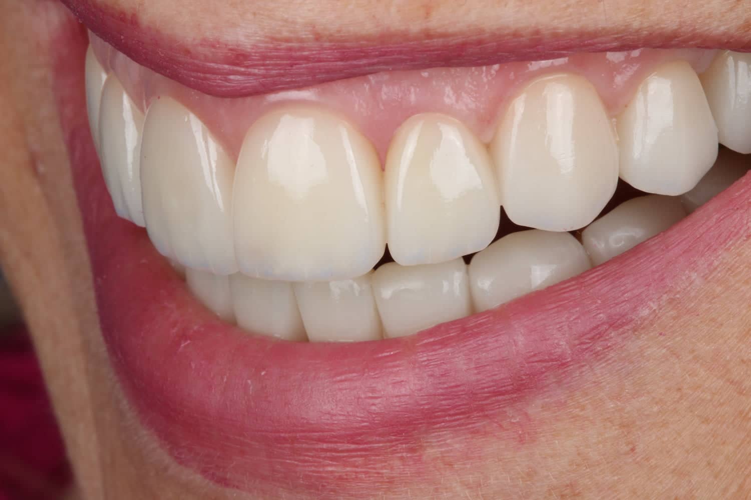 Rehabilitación completa adhesiva por desgaste en paciente joven