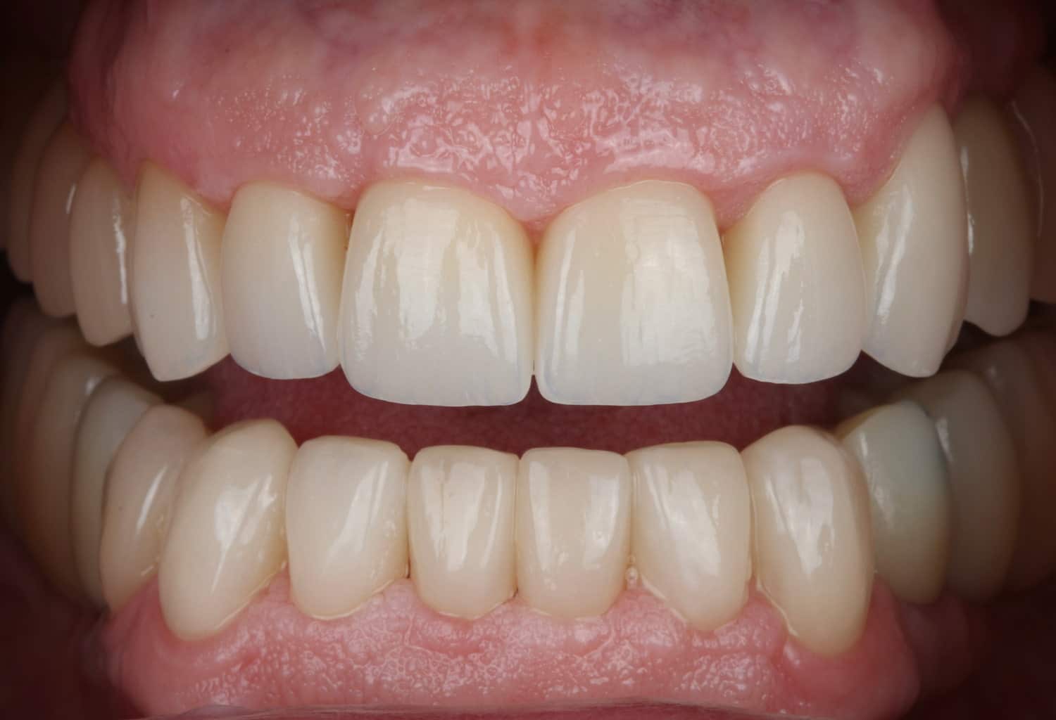 Rehabilitación completa adhesiva por desgaste dental severo en paciente de avanzada edad