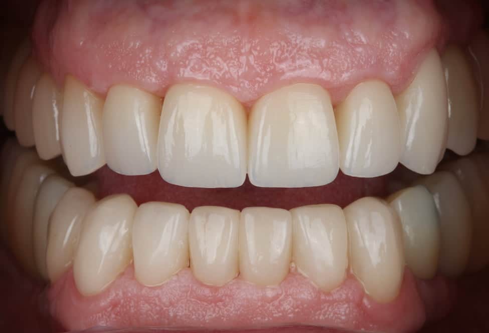 Rehabilitación completa adhesiva por desgaste dental severo en paciente de avanzada edad