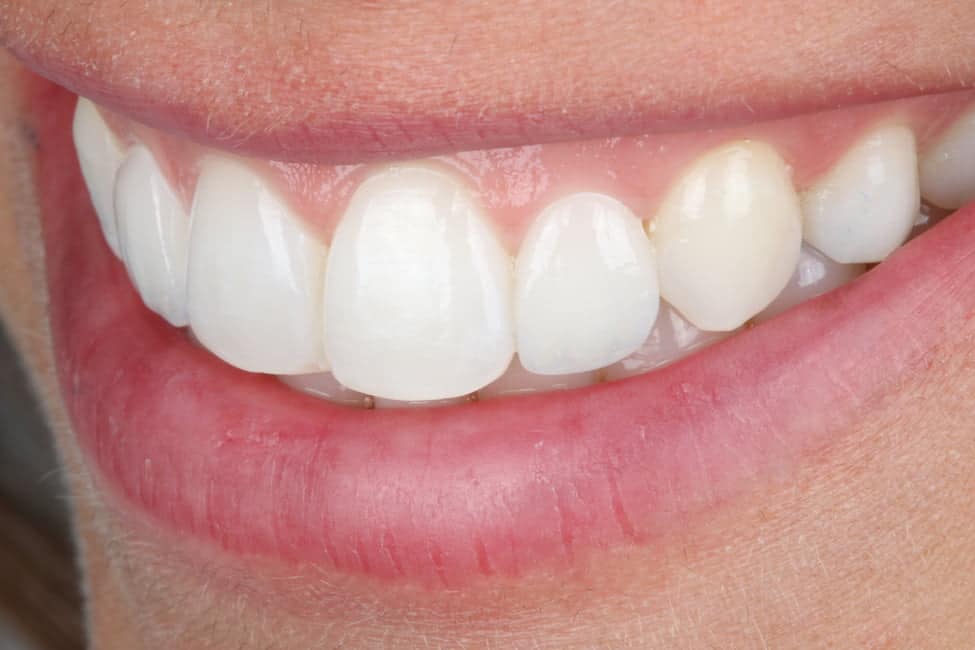 Blanqueamiento dental y carillas en dientes con restauraciones obsoletas