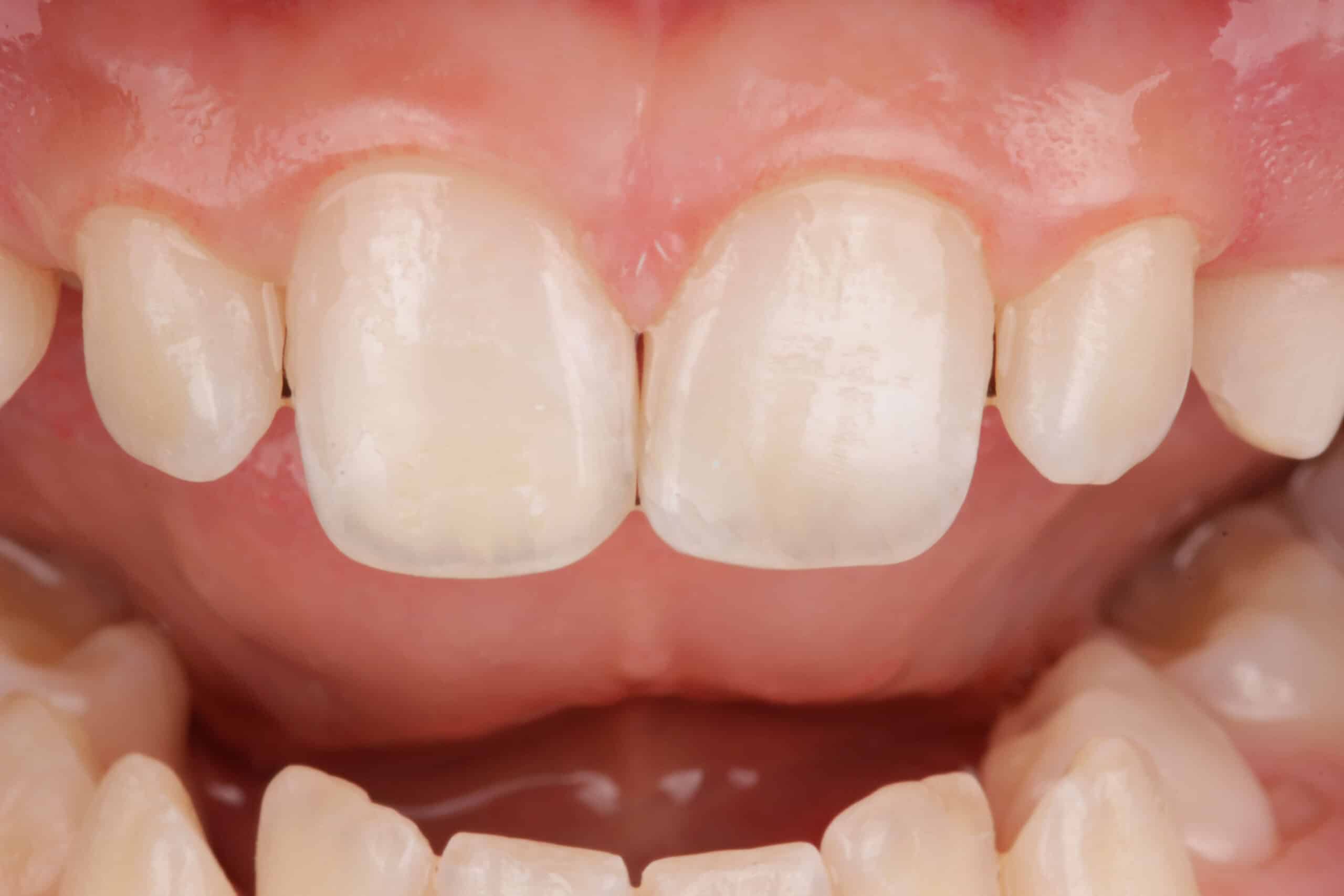 Reposición de diente fracturado con el propio fragmento del paciente