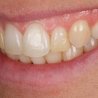 Blanqueamiento dental y carillas en dientes con restauraciones obsoletas