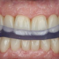 Rehabilitación completa adhesiva por desgaste dental severo en paciente de avanzada edad