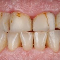Rehabilitación completa adhesiva por desgaste dental severo en paciente de avanzada edad