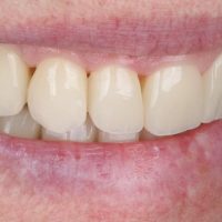 Rehabilitación completa adhesiva por desgaste dental severo en paciente de mediana edad