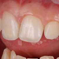 Reposición de diente fracturado con el propio fragmento del paciente