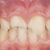 Reposición de diente fracturado con el propio fragmento del paciente