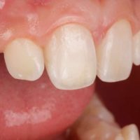 Reposición de diente fracturado con el propio fragmento del paciente