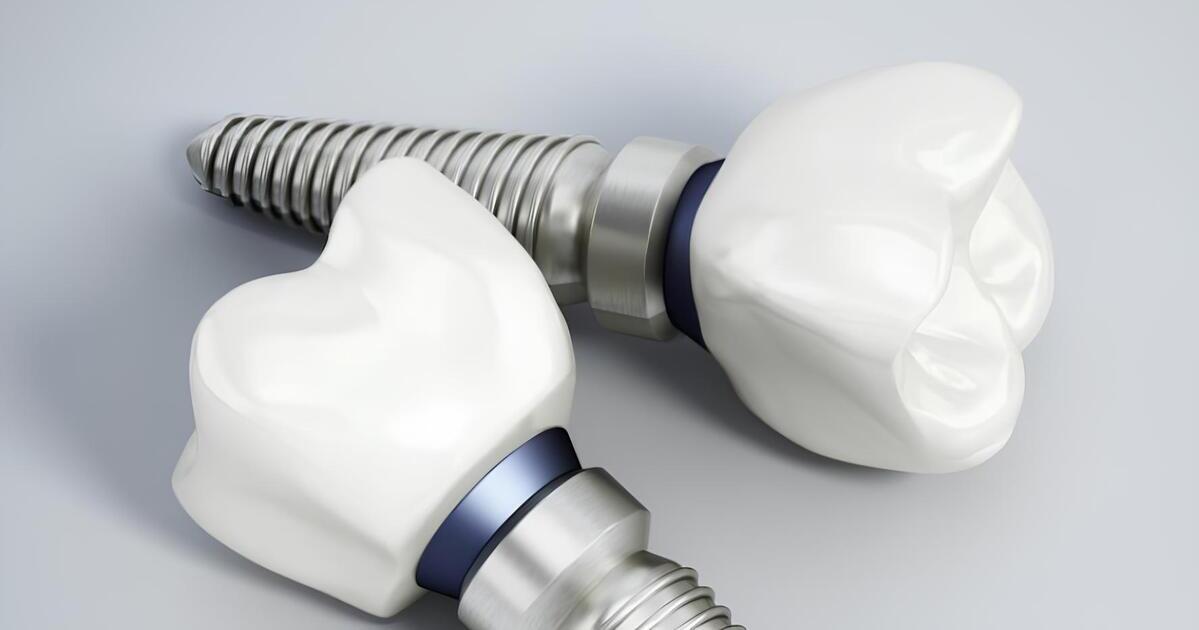 Implantes dentales