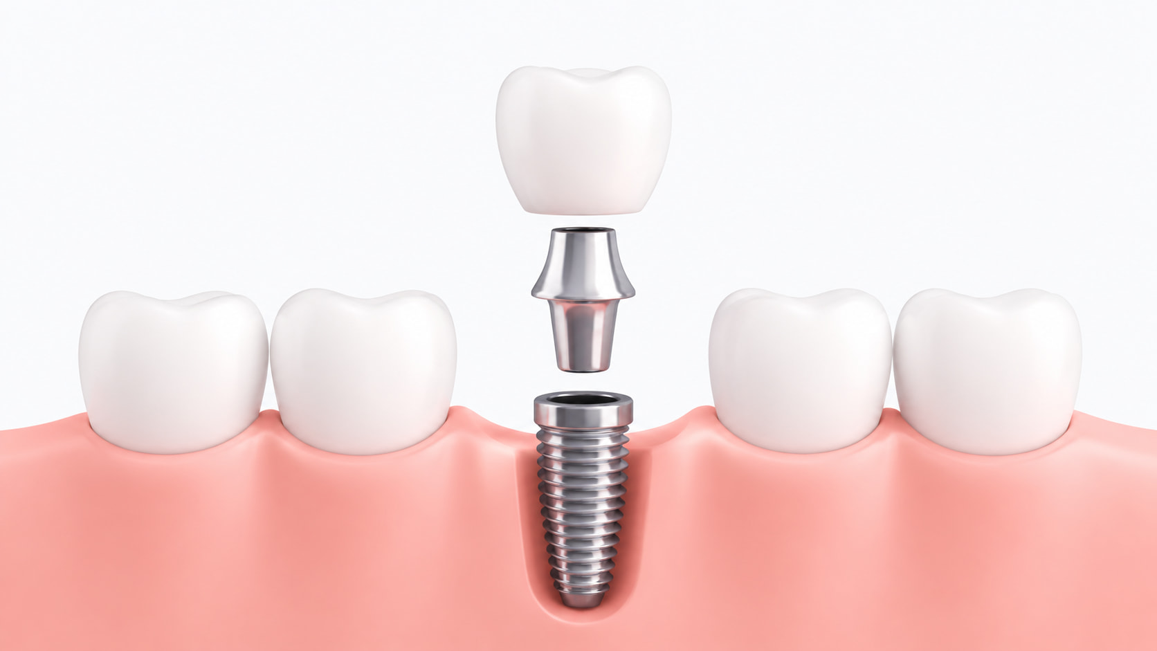Precio de los implantes dentales ¿Qué incluye un presupuesto seguro