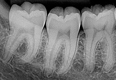 una radiografía periapical