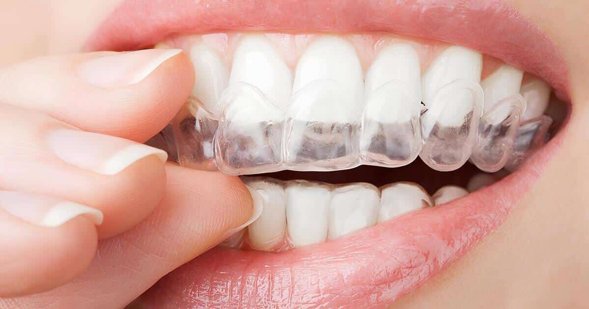 Retenedor dental